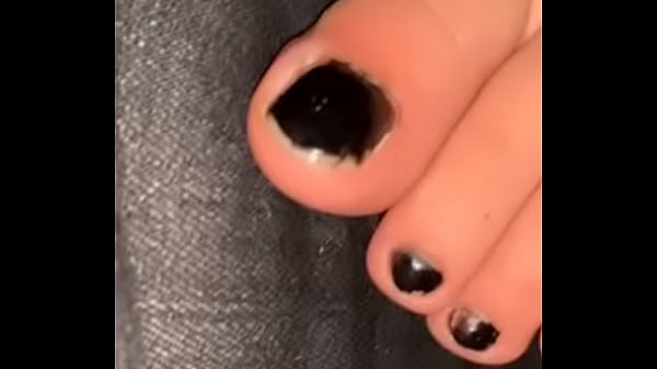 Pied ongle
